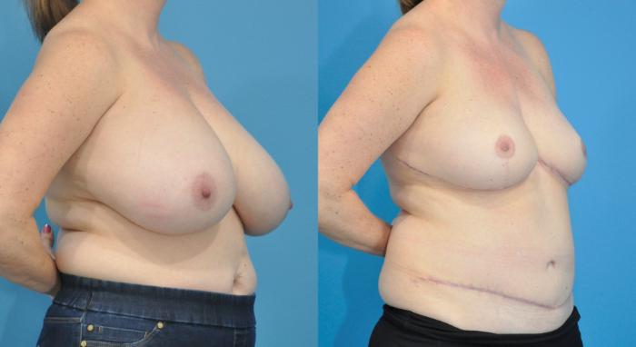 Before & After Breast Reconstruction with DIEP/TRAM Flaps Case 206 View #1 View in Northbrook, IL