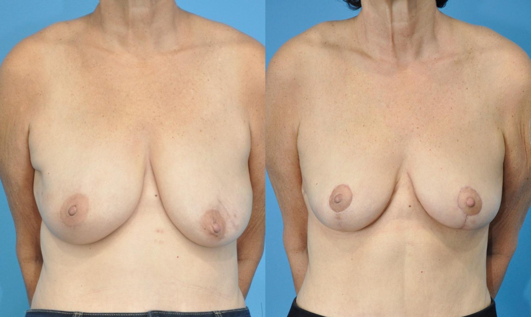 Before & After Breast Reconstruction with DIEP/TRAM Flaps Case 210 View #1 View in North Shore, IL