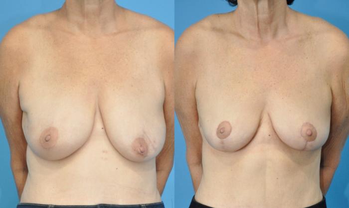 Before & After Breast Reconstruction with DIEP/TRAM Flaps Case 210 View #1 View in Northbrook, IL