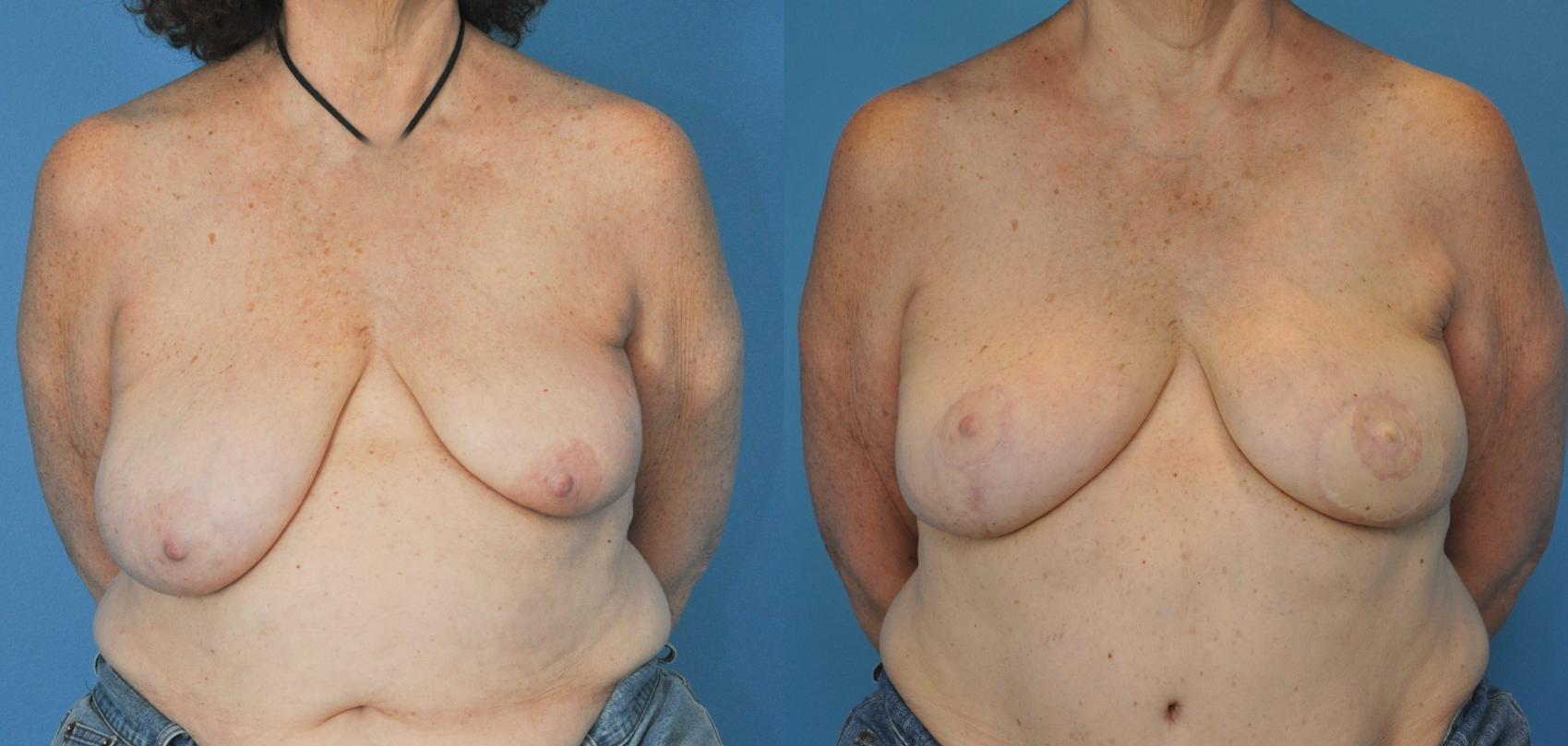 Before & After Breast Reconstruction with DIEP/TRAM Flaps Case 24 View #1 View in Northbrook, IL