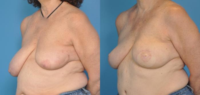 Before & After Breast Reconstruction with DIEP/TRAM Flaps Case 24 View #2 View in North Shore, IL
