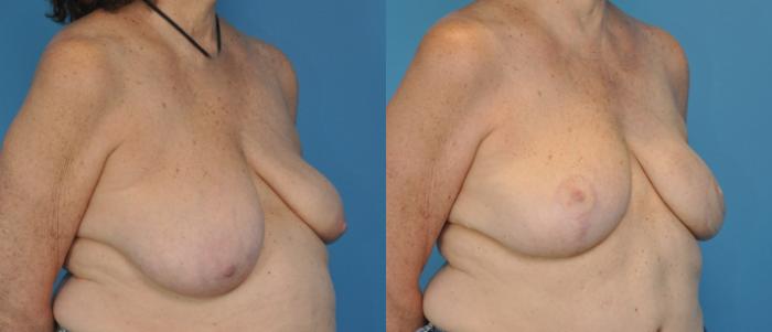 Before & After Breast Reconstruction with DIEP/TRAM Flaps Case 24 View #3 View in North Shore, IL