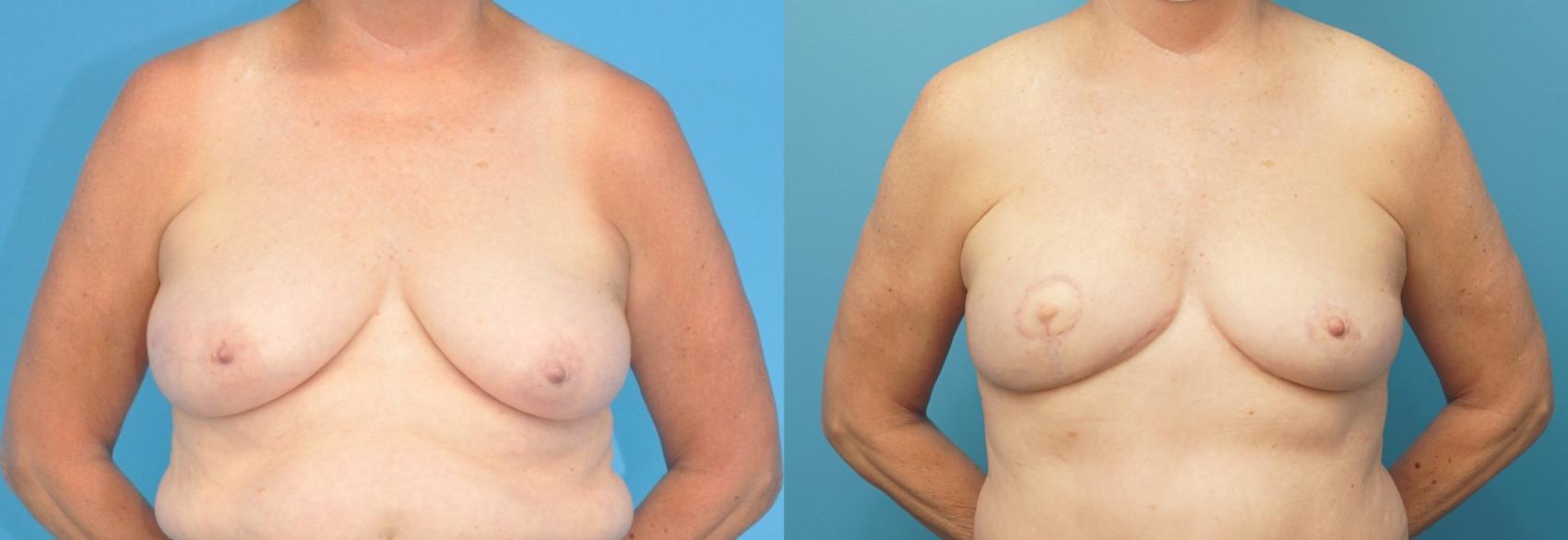 Before & After Breast Reconstruction with DIEP/TRAM Flaps Case 295 Front View in North Shore, IL