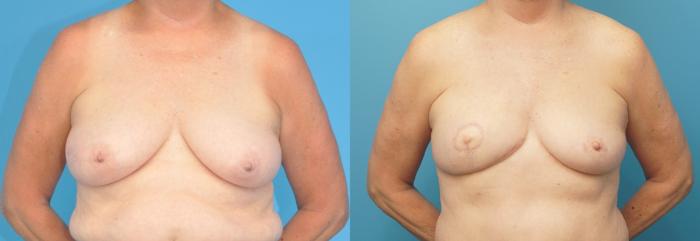 Before & After Breast Reconstruction with DIEP/TRAM Flaps Case 295 Front View in Northbrook, IL