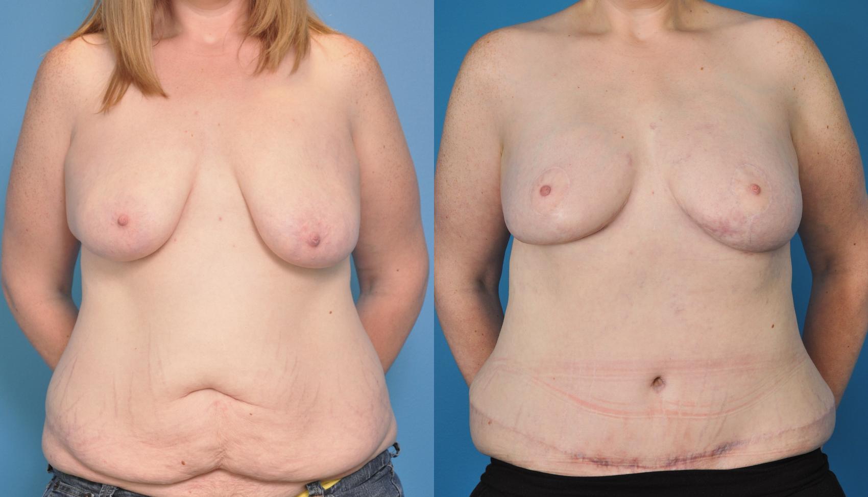 Before & After Breast Reconstruction with DIEP/TRAM Flaps Case 33 View #1 View in North Shore, IL