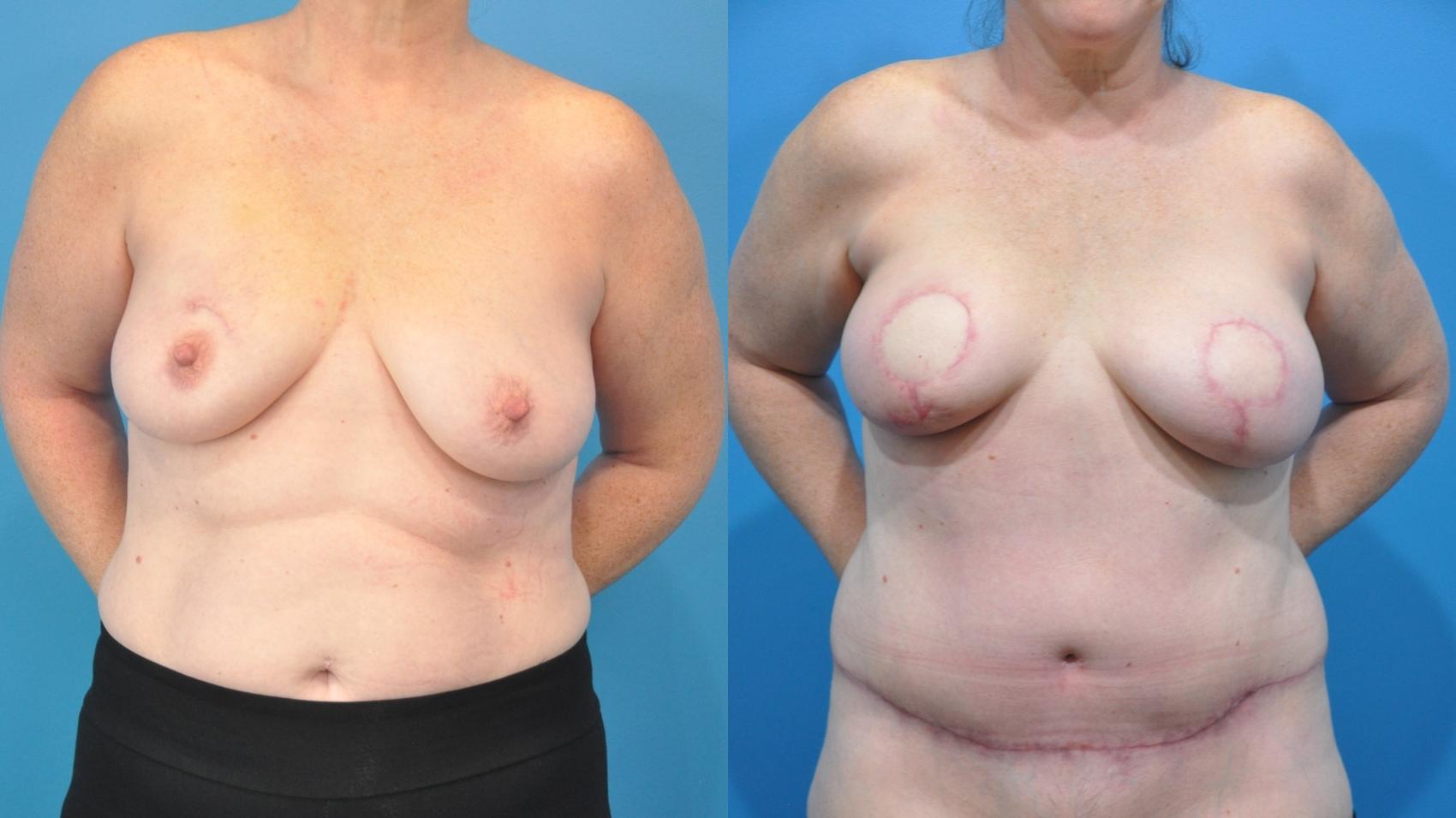 Before & After Breast Reconstruction with DIEP/TRAM Flaps Case 355 Front View in North Shore, IL