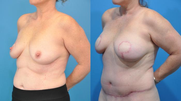 Before & After Breast Reconstruction with DIEP/TRAM Flaps Case 355 Left Oblique View in North Shore, IL