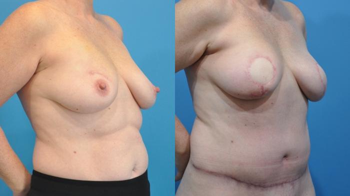 Before & After Breast Reconstruction with DIEP/TRAM Flaps Case 355 Right Oblique View in North Shore, IL