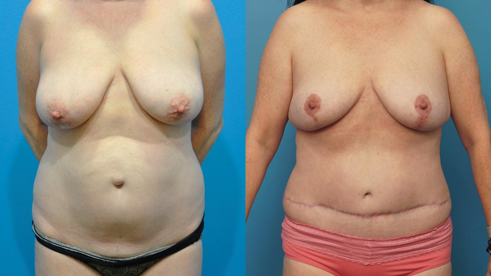 Before & After Breast Reconstruction with DIEP/TRAM Flaps Case 364 Front View in Northbrook, IL