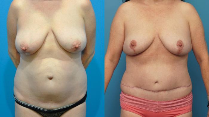 Before & After Breast Reconstruction with DIEP/TRAM Flaps Case 364 Front View in Northbrook, IL