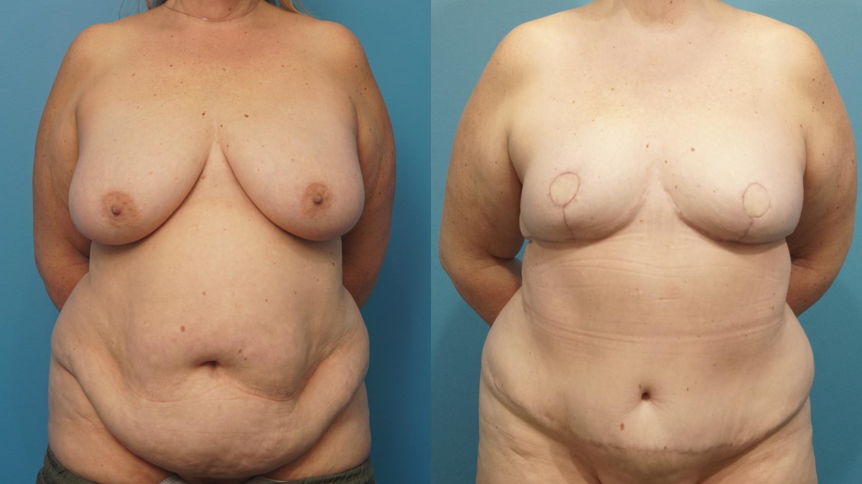 Before & After Breast Reconstruction with DIEP/TRAM Flaps Case 476 Front View in North Shore, IL