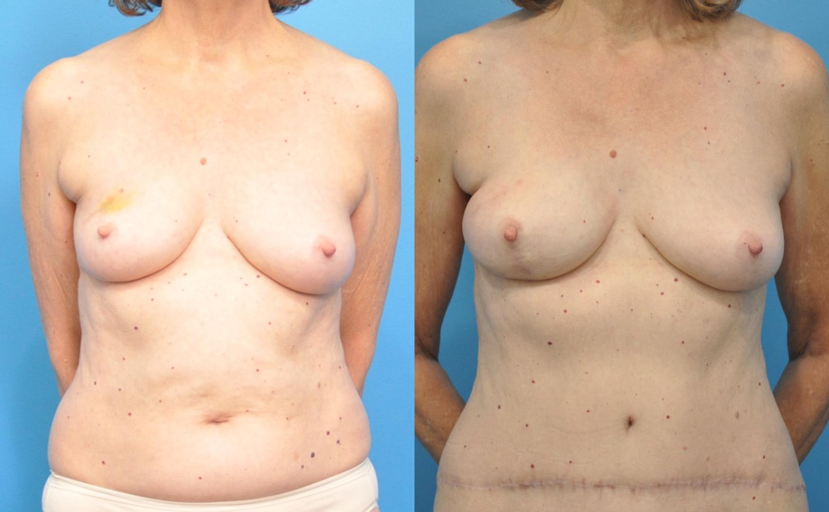 Before & After Breast Reconstruction with DIEP/TRAM Flaps Case 48 View #1 View in Northbrook, IL