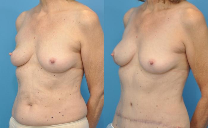Before & After Breast Reconstruction with DIEP/TRAM Flaps Case 48 View #2 View in North Shore, IL
