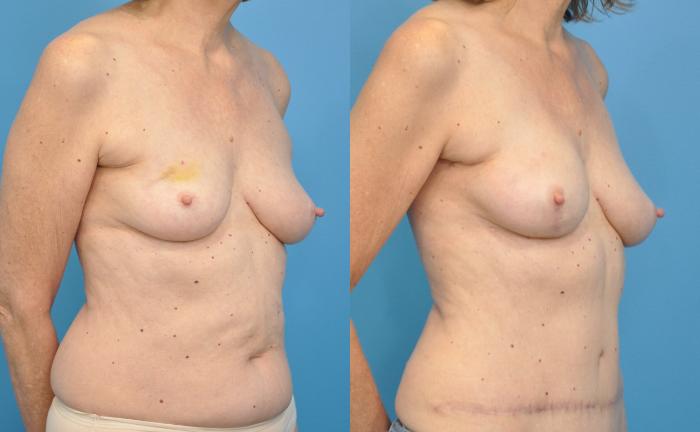 Before & After Breast Reconstruction with DIEP/TRAM Flaps Case 48 View #3 View in North Shore, IL