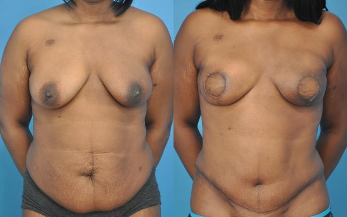 Before & After Breast Reconstruction with DIEP/TRAM Flaps Case 52 View #1 View in Northbrook, IL