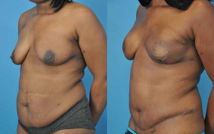 Before & After Breast Reconstruction with DIEP/TRAM Flaps Case 52 View #2 View in North Shore, IL