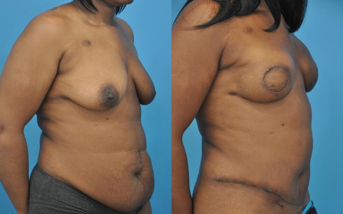 Before & After Breast Reconstruction with DIEP/TRAM Flaps Case 52 View #3 View in North Shore, IL