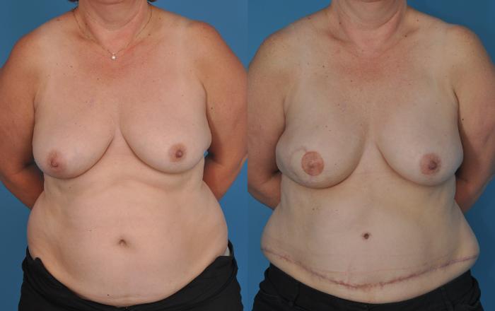 Before & After Breast Reconstruction with DIEP/TRAM Flaps Case 69 View #1 View in North Shore, IL