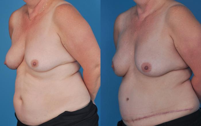 Before & After Breast Reconstruction with DIEP/TRAM Flaps Case 69 View #2 View in North Shore, IL
