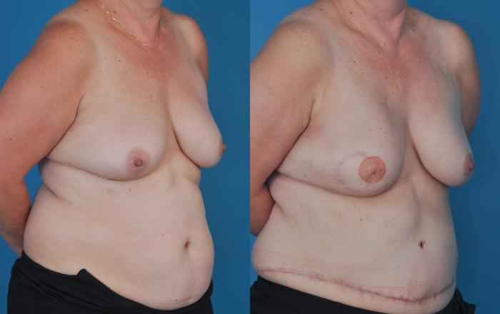 Before & After Breast Reconstruction with DIEP/TRAM Flaps Case 69 View #3 View in North Shore, IL