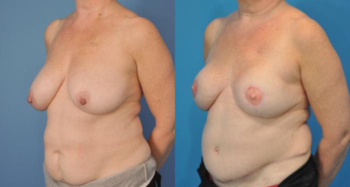 Before & After Breast Reconstruction with DIEP/TRAM Flaps Case 75 View #1 View in Northbrook, IL