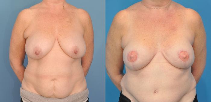 Before & After Breast Reconstruction with DIEP/TRAM Flaps Case 75 View #2 View in Northbrook, IL