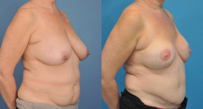 Before & After Breast Reconstruction with DIEP/TRAM Flaps Case 75 View #3 View in Northbrook, IL