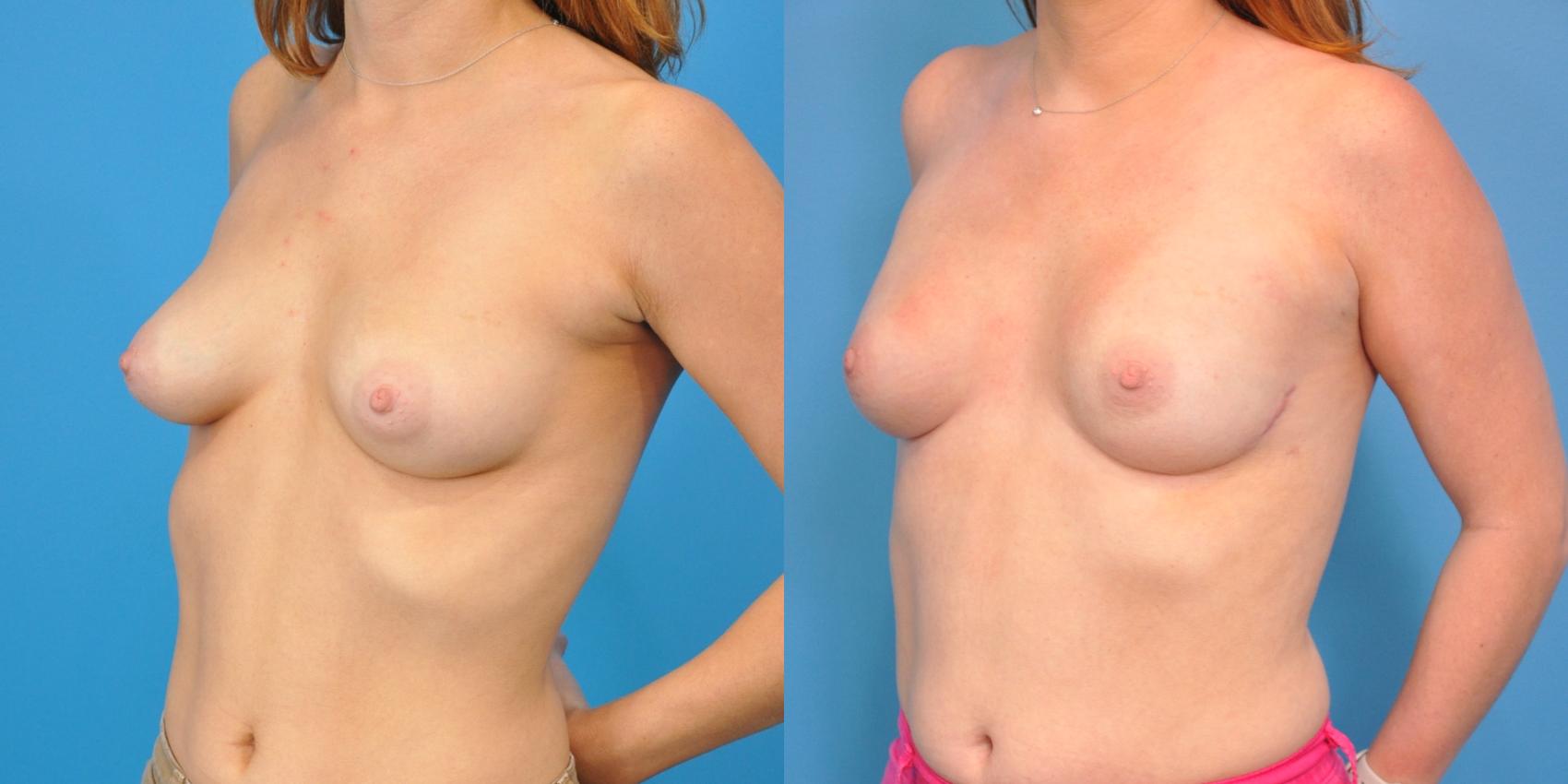Before & After Breast Reconstruction with Implants Case 108 View #1 View in North Shore, IL