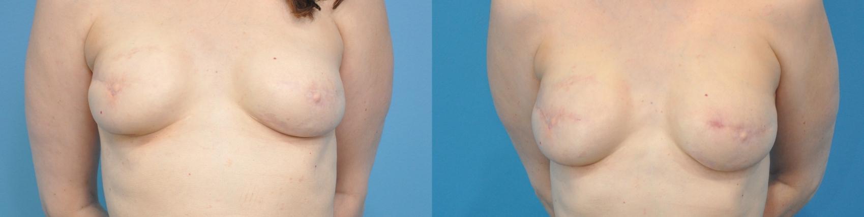 Before & After Breast Reconstruction with Implants Case 118 View #1 View in Northbrook, IL