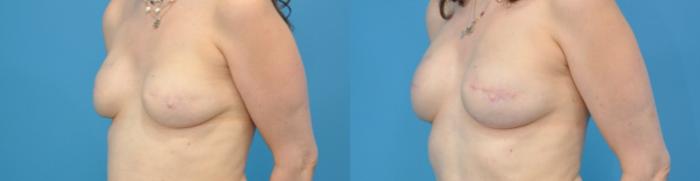 Before & After Breast Reconstruction with Implants Case 118 View #3 View in North Shore, IL