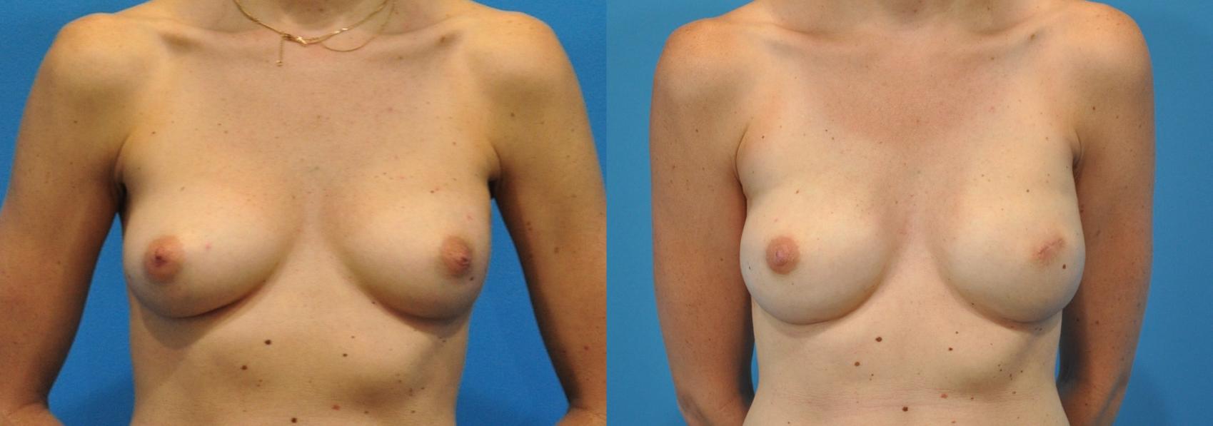 Before & After Breast Reconstruction with Implants Case 134 View #1 View in Northbrook, IL