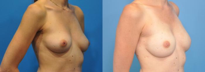 Before & After Breast Reconstruction with Implants Case 134 View #2 View in Northbrook, IL