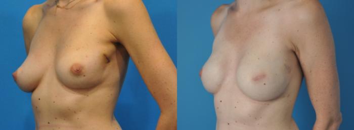 Before & After Breast Reconstruction with Implants Case 134 View #3 View in Northbrook, IL