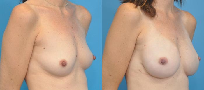 Before & After Breast Reconstruction with Implants Case 138 View #2 View in North Shore, IL