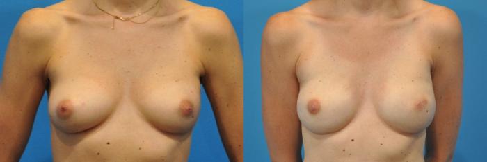 Before & After Breast Reconstruction with Implants Case 143 View #1 View in Northbrook, IL