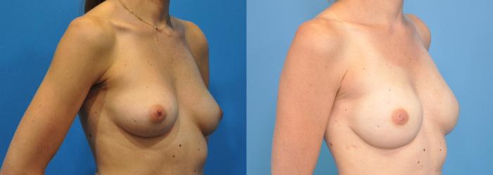 Before & After Breast Reconstruction with Implants Case 143 View #2 View in Northbrook, IL