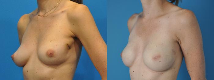 Before & After Breast Reconstruction with Implants Case 143 View #3 View in Northbrook, IL