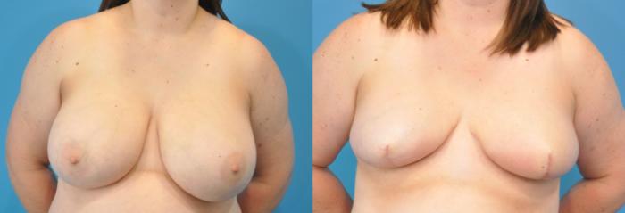 Before & After Breast Reconstruction with Implants Case 144 View #1 View in North Shore, IL