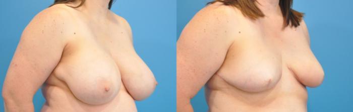 Before & After Breast Reconstruction with Implants Case 144 View #2 View in North Shore, IL