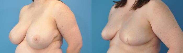 Before & After Breast Reconstruction with Implants Case 144 View #3 View in North Shore, IL