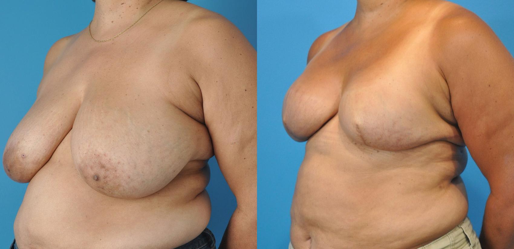 Before & After Breast Reconstruction with Implants Case 15 View #1 View in North Shore, IL