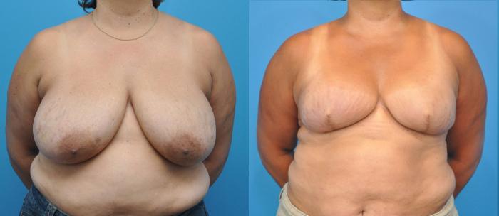 Before & After Breast Reconstruction with Implants Case 15 View #2 View in North Shore, IL