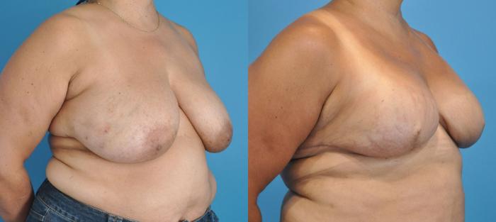 Before & After Breast Reconstruction with Implants Case 15 View #3 View in North Shore, IL