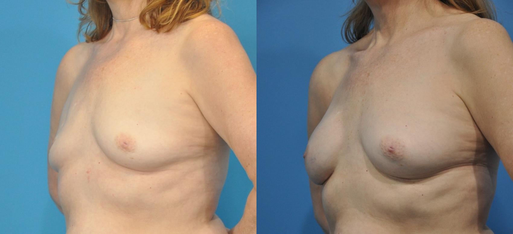 Before & After Breast Reconstruction with Implants Case 165 View #1 View in Northbrook, IL
