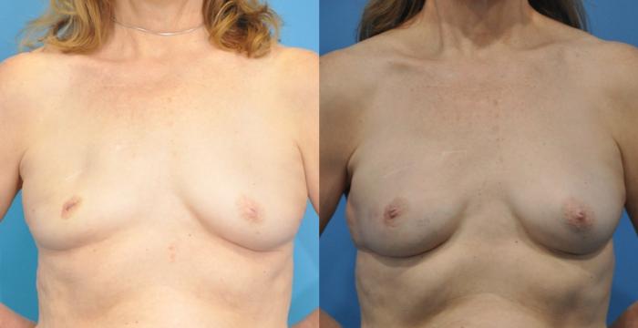 Before & After Breast Reconstruction with Implants Case 165 View #2 View in Northbrook, IL