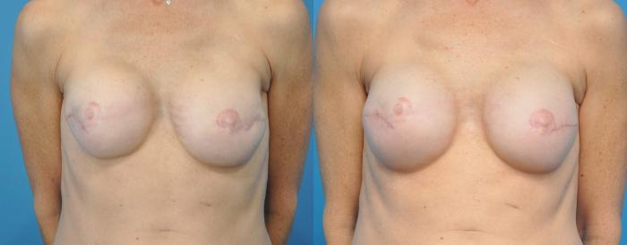Before & After Breast Reconstruction with Implants Case 168 View #1 View in North Shore, IL