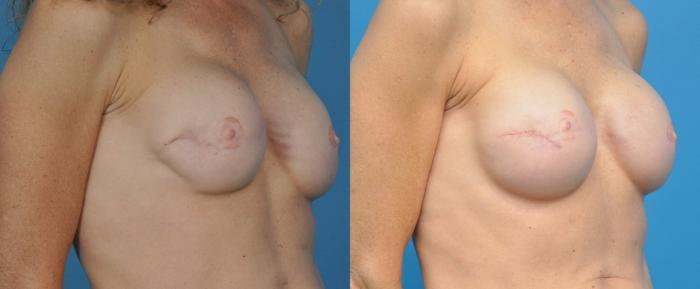 Before & After Breast Reconstruction with Implants Case 168 View #2 View in North Shore, IL