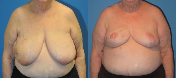 Before & After Breast Reconstruction with Implants Case 17 View #1 View in North Shore, IL