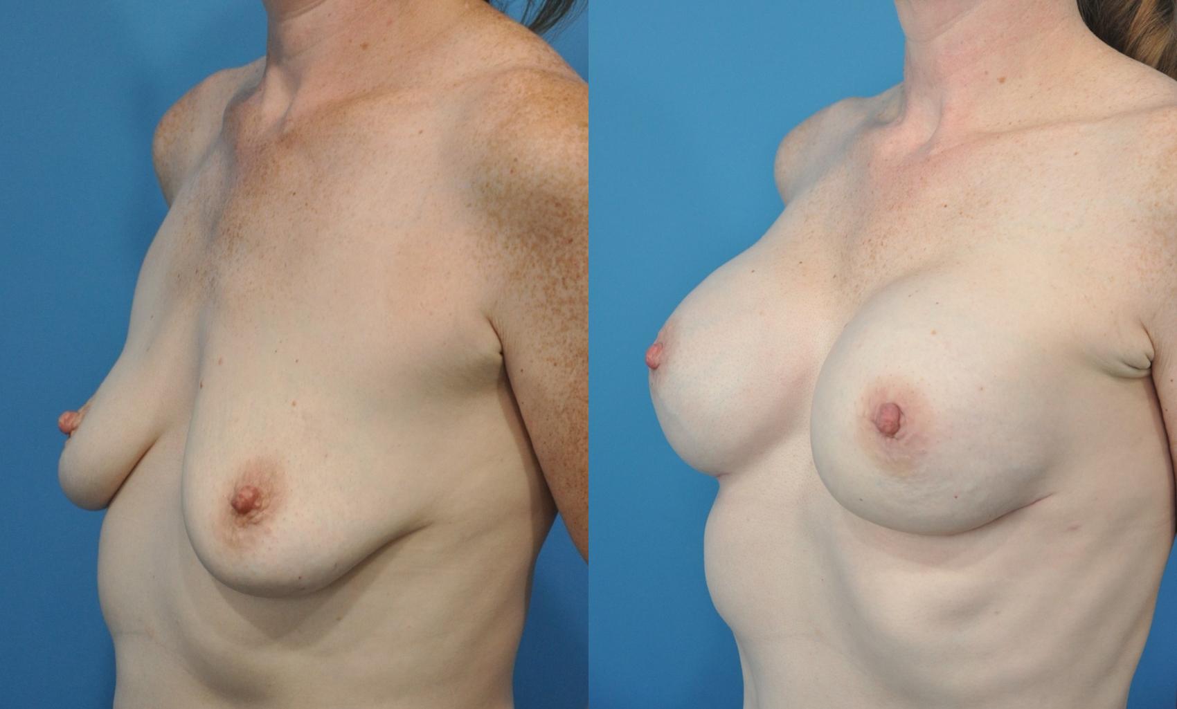 Before & After Breast Reconstruction with Implants Case 171 View #1 View in North Shore, IL