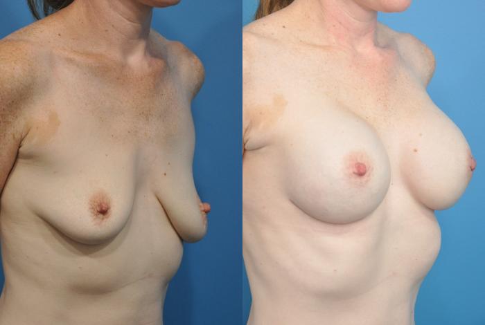 Before & After Breast Reconstruction with Implants Case 171 View #2 View in North Shore, IL